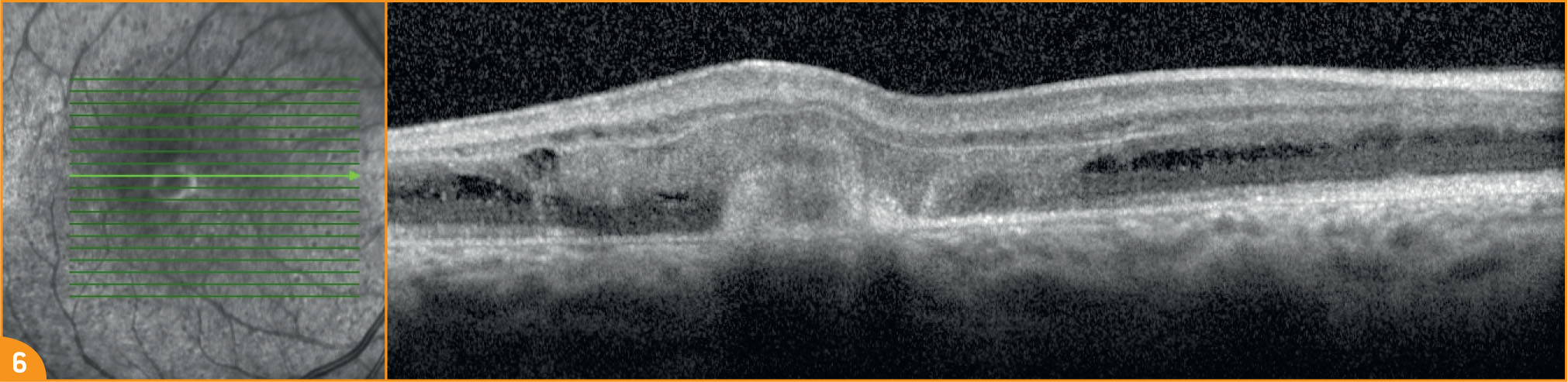 Une anastomose rétino-rétinienne chez un jeune garçon de 10 ans - Figure 6