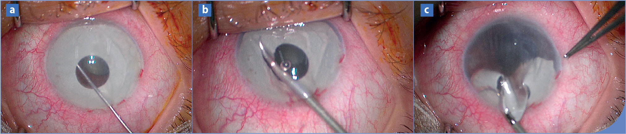 Complications oculaires des implants iriens - Figure 3