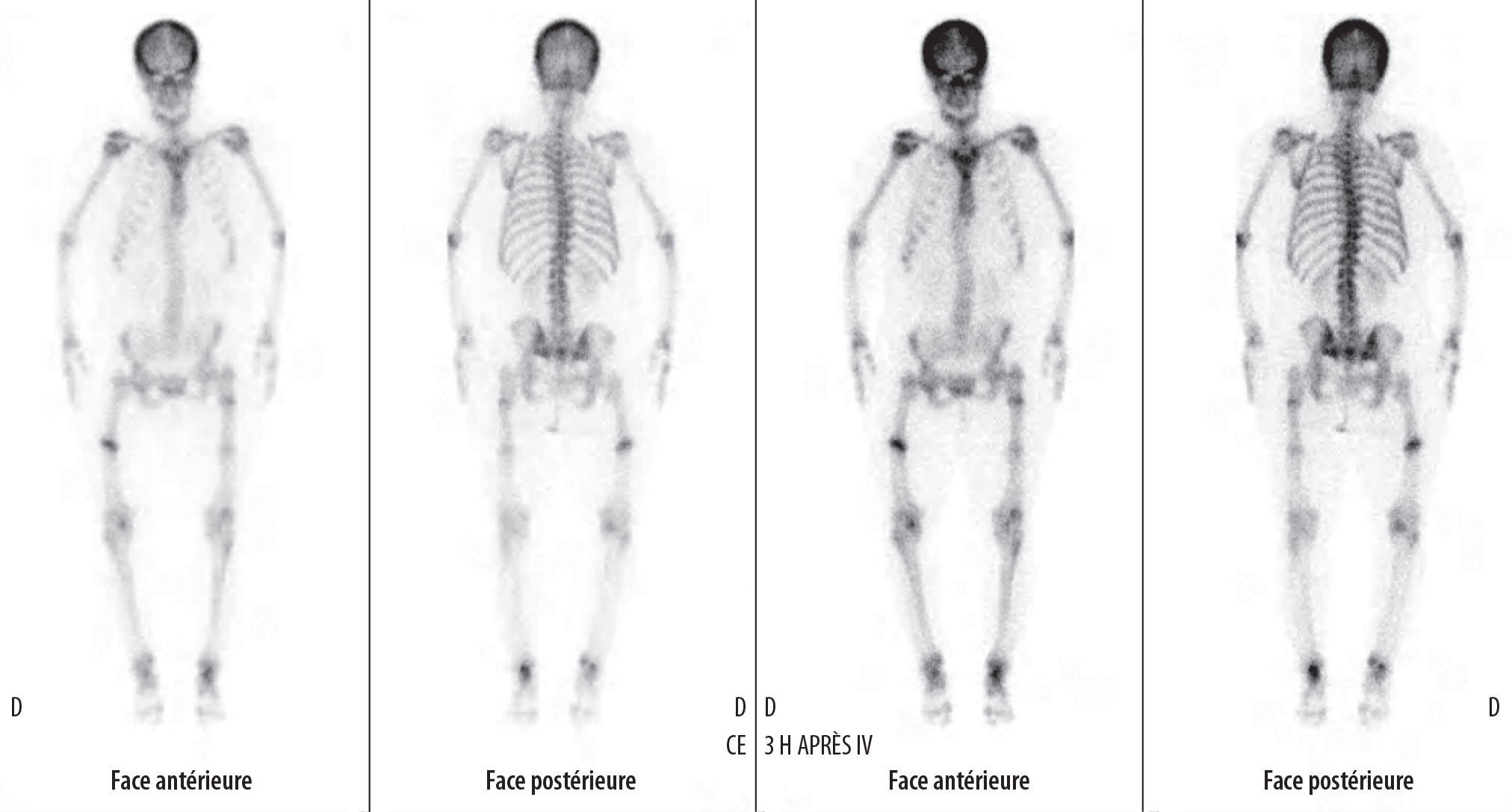 Une “aPhaire” d’os : l’hypophosphatémie liée à l’X - Figure 2