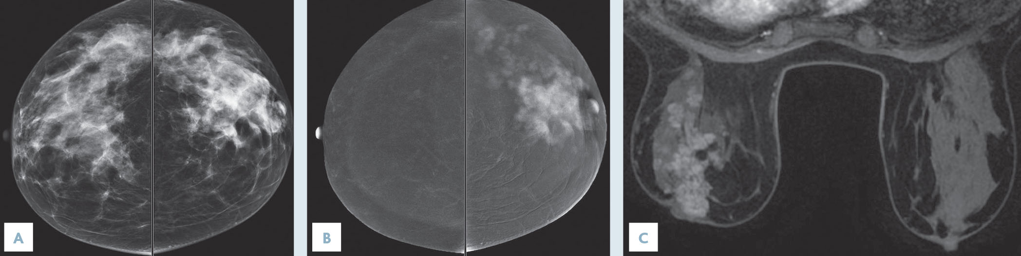 L'angiomammographie : nouvelle technique d'imagerie diagnostique des lésions du sein - Figure 2