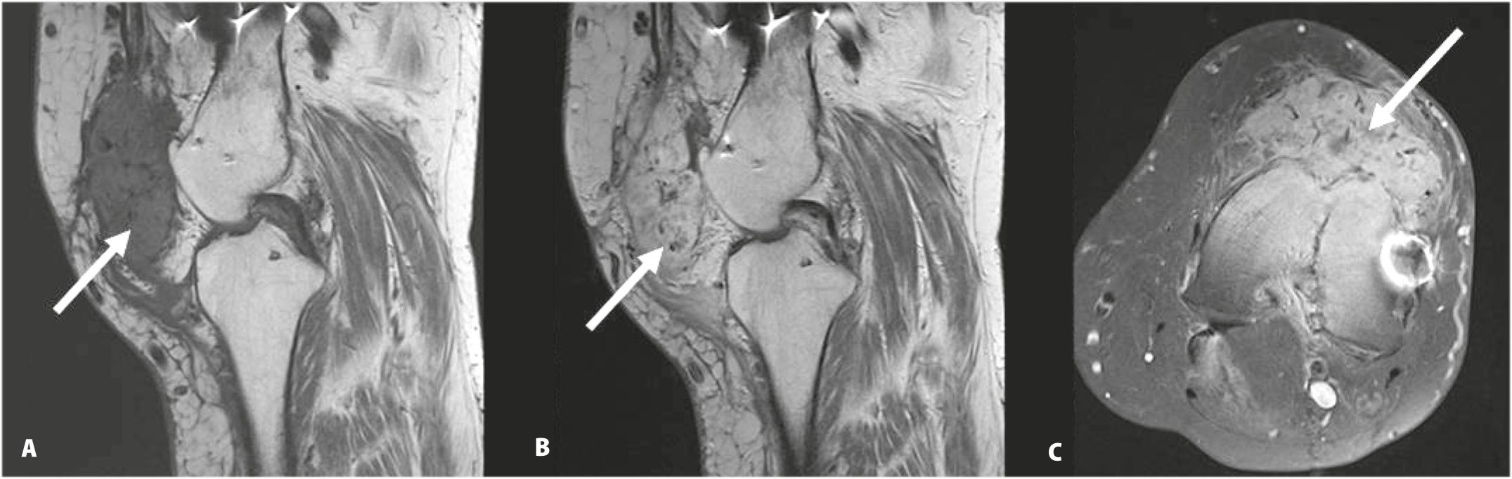 Une localisation métastatique inhabituelle d’un carcinome rénal à cellules claires : la patella-Figure 3