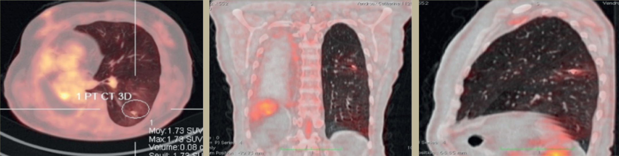 Traitement d'un cancer du poumon par radiothérapie stéréotaxique - Figure 4