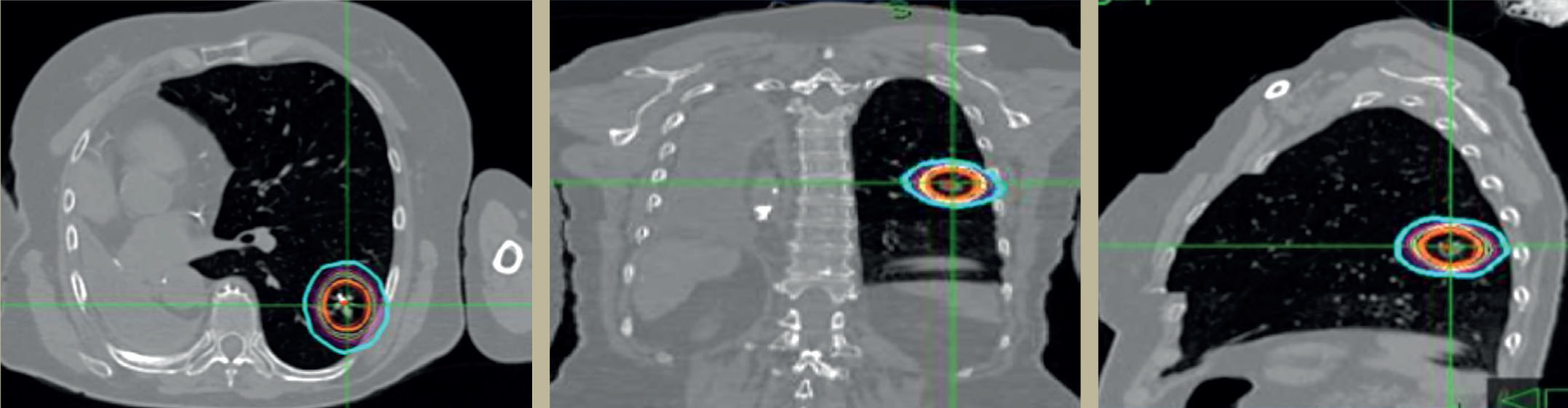 Traitement d'un cancer du poumon par radiothérapie stéréotaxique - Figure 2