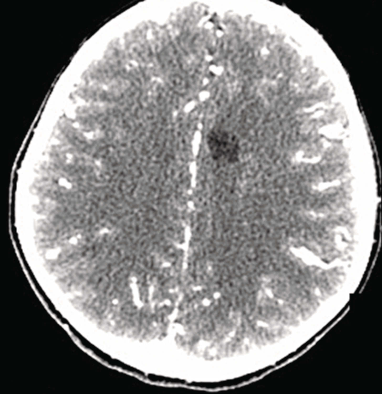 Localisation intranasale d’un projectile après un traumatisme balistique craniofacial - Figure 2