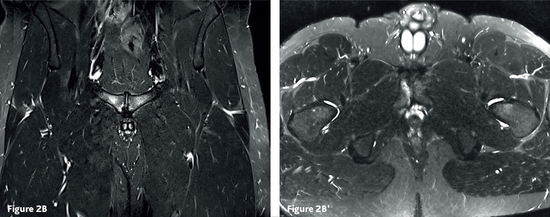 Pubalgie : ostéoarthropathie pubienne et enthésopathie du tendon conjoint long adducteur-gracile - Figure 3