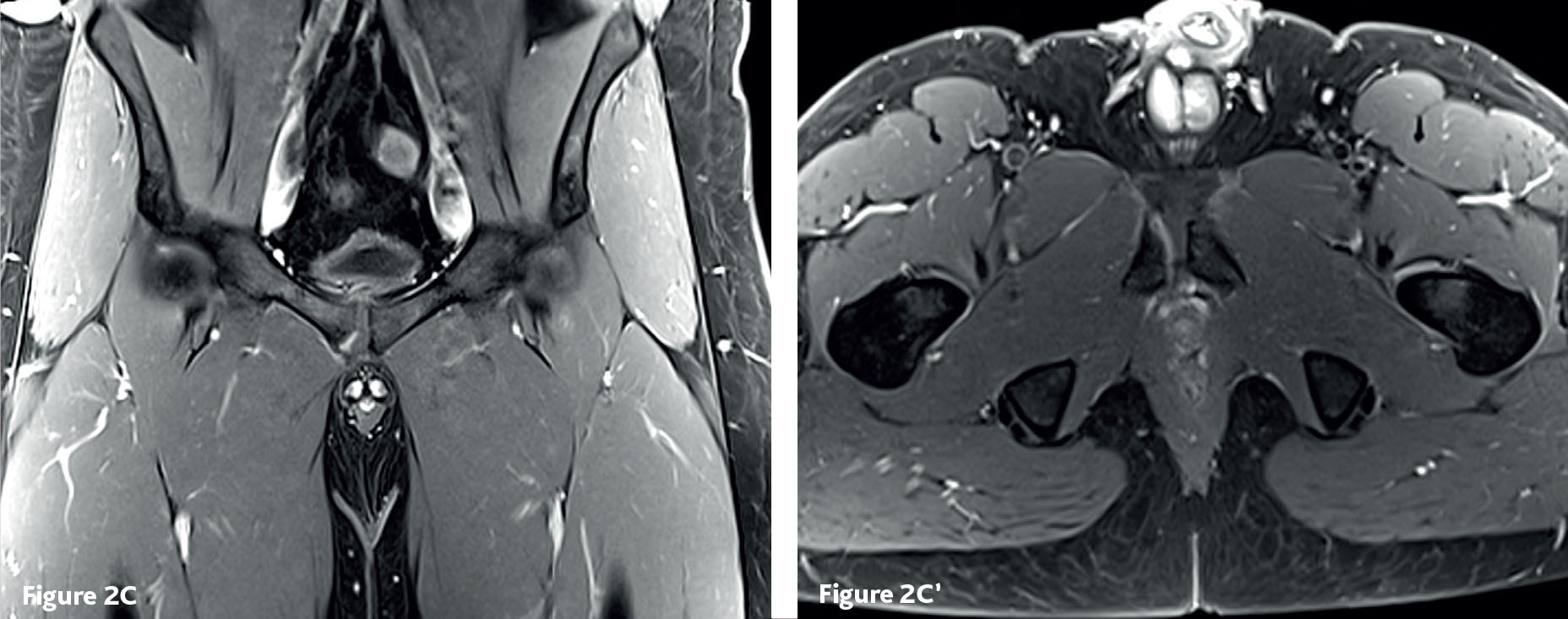 Pubalgie : ostéoarthropathie pubienne et enthésopathie du tendon conjoint long adducteur-gracile - Figure 4