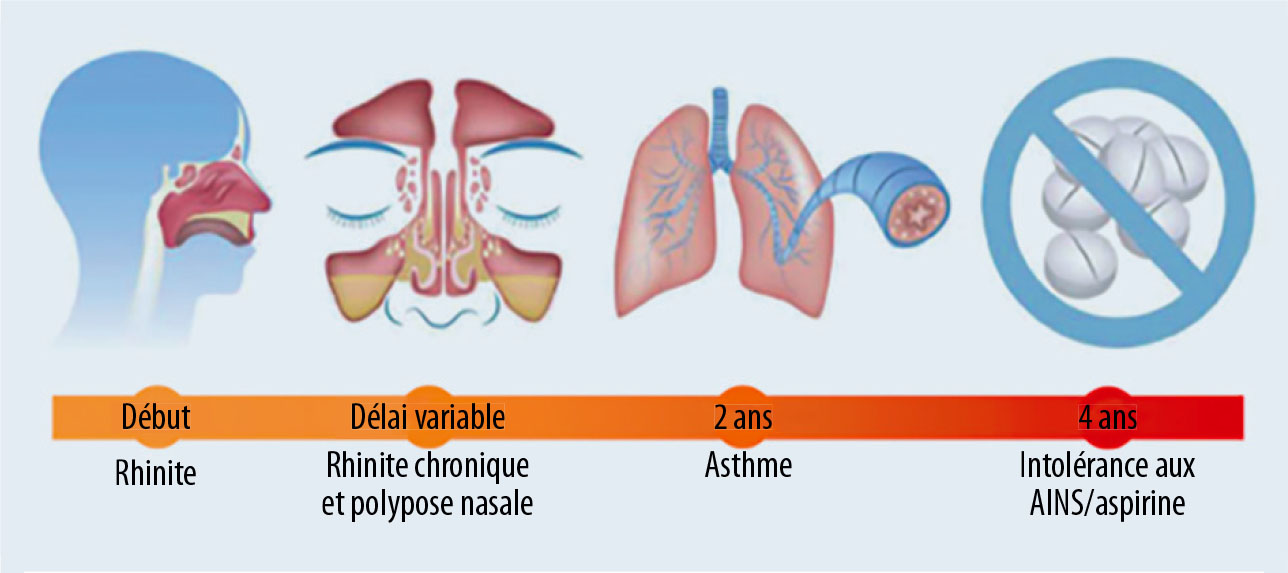 Asthme induit par l’aspirine - Figure 3