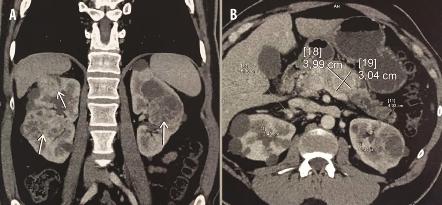 La maladie de Von Hippel-Lindau révélée par une tumeur du sac endolymphatique - Figure 2