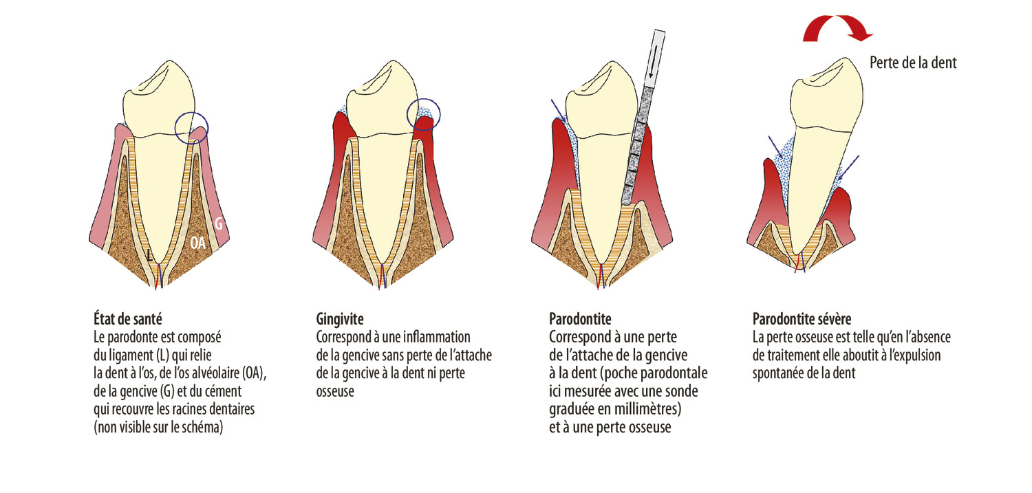 Maladies parodontales et accident vasculaire cérébral - Figure 2