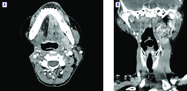 Réponse spectaculaire à l’entrectinib, un inhibiteur de NTRK, chez une patiente porteuse d’une tumeur sous-mandibulaire rare - Figure 2