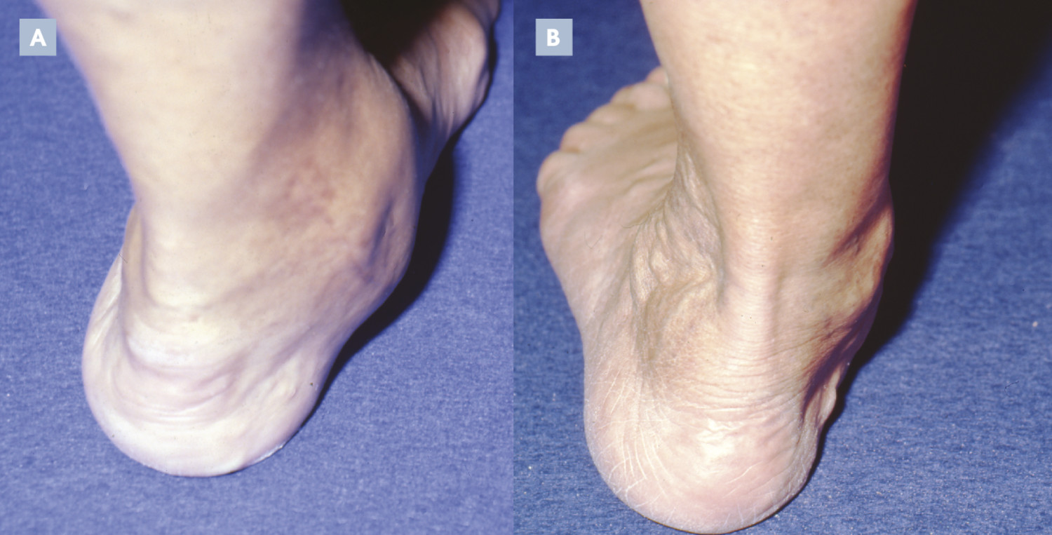 Les pathologies du tendon tibial postérieur - Figure 2
