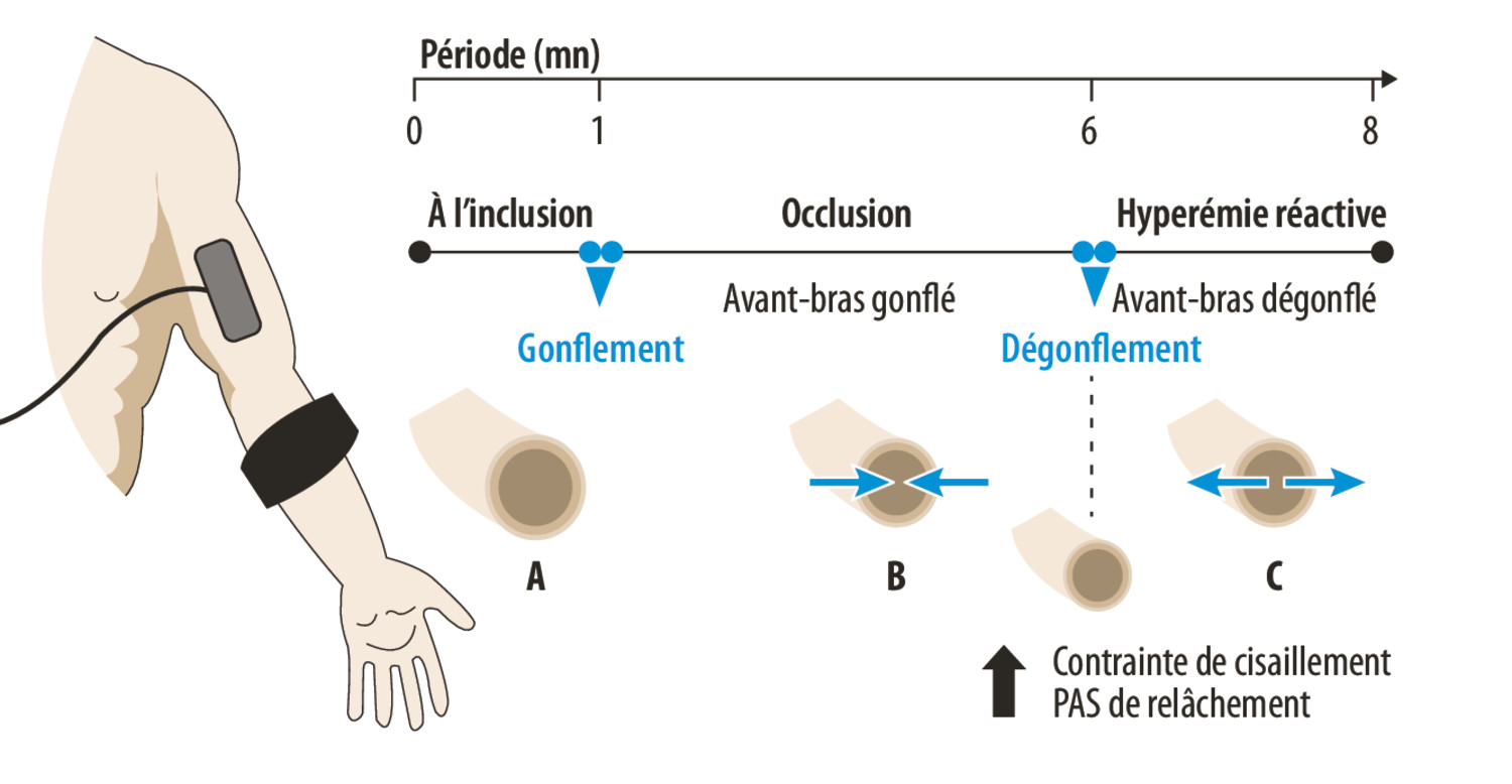 Goutte et hyperuricémie - Figure 2
