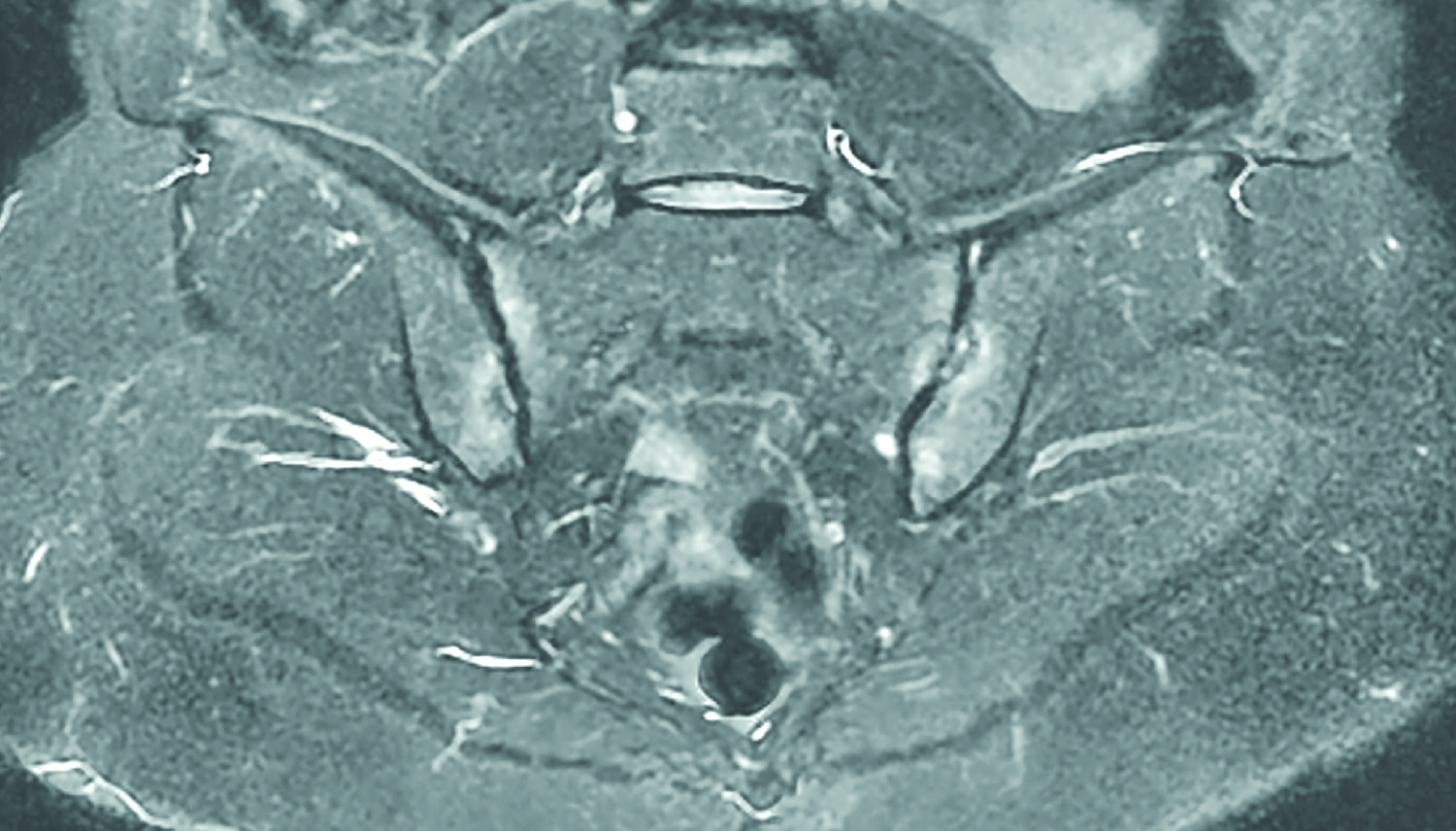 Quelle imagerie pour l’évaluation des articulations sacro-iliaques dans la spondyloarthrite axiale ? - Figure 1