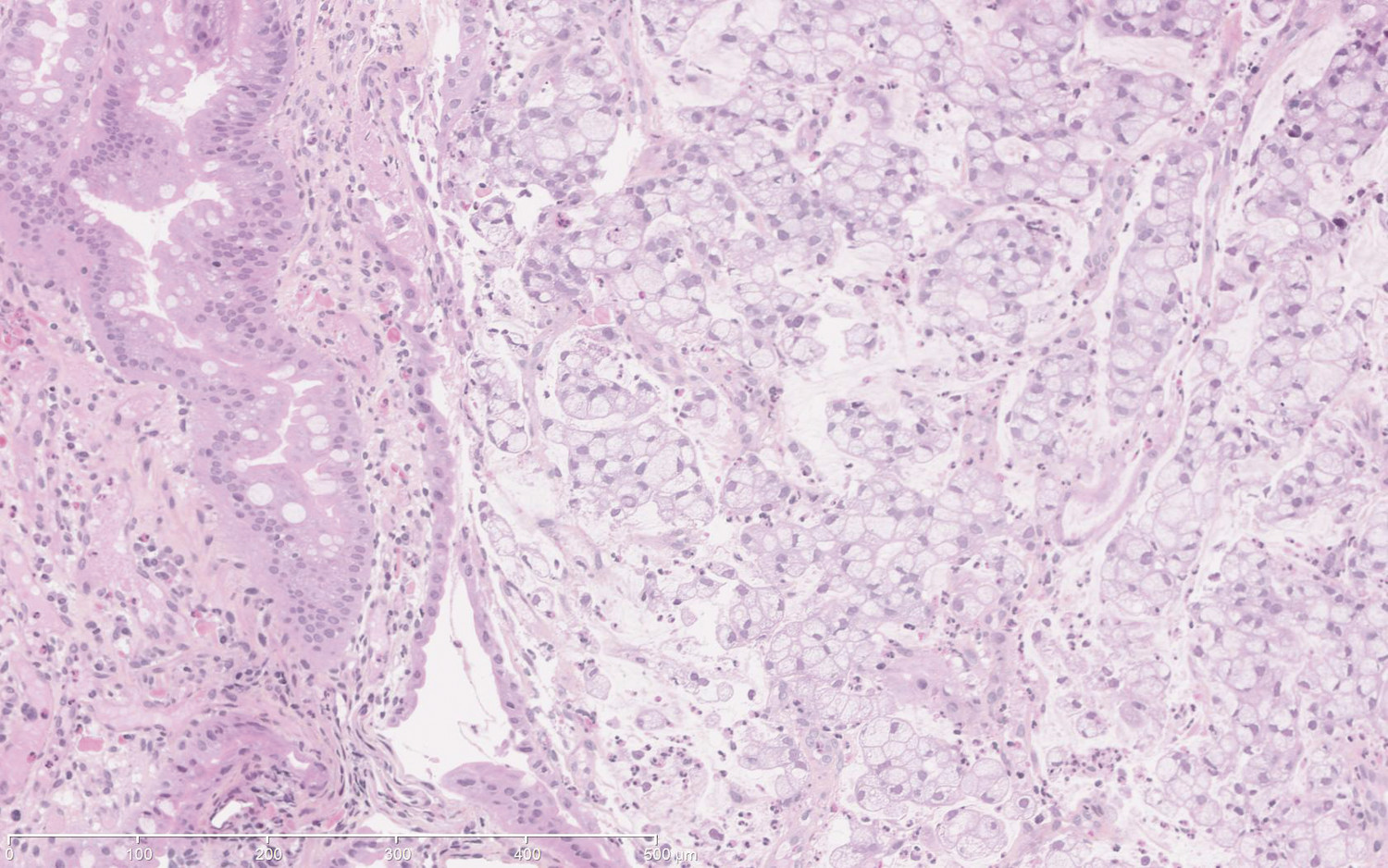 Sténose bulbaire chez une patiente atteinte de maladie de Crohn pédiatrique - Figure 3