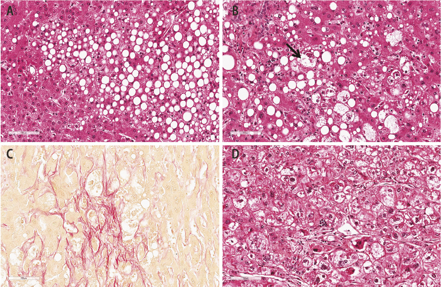 De la stéatopathie métabolique au carcinome hépatocellulaire - Figure 1