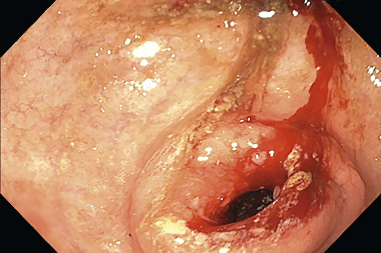 Sténose bulbaire chez une patiente atteinte de maladie de Crohn pédiatrique - Figure 1