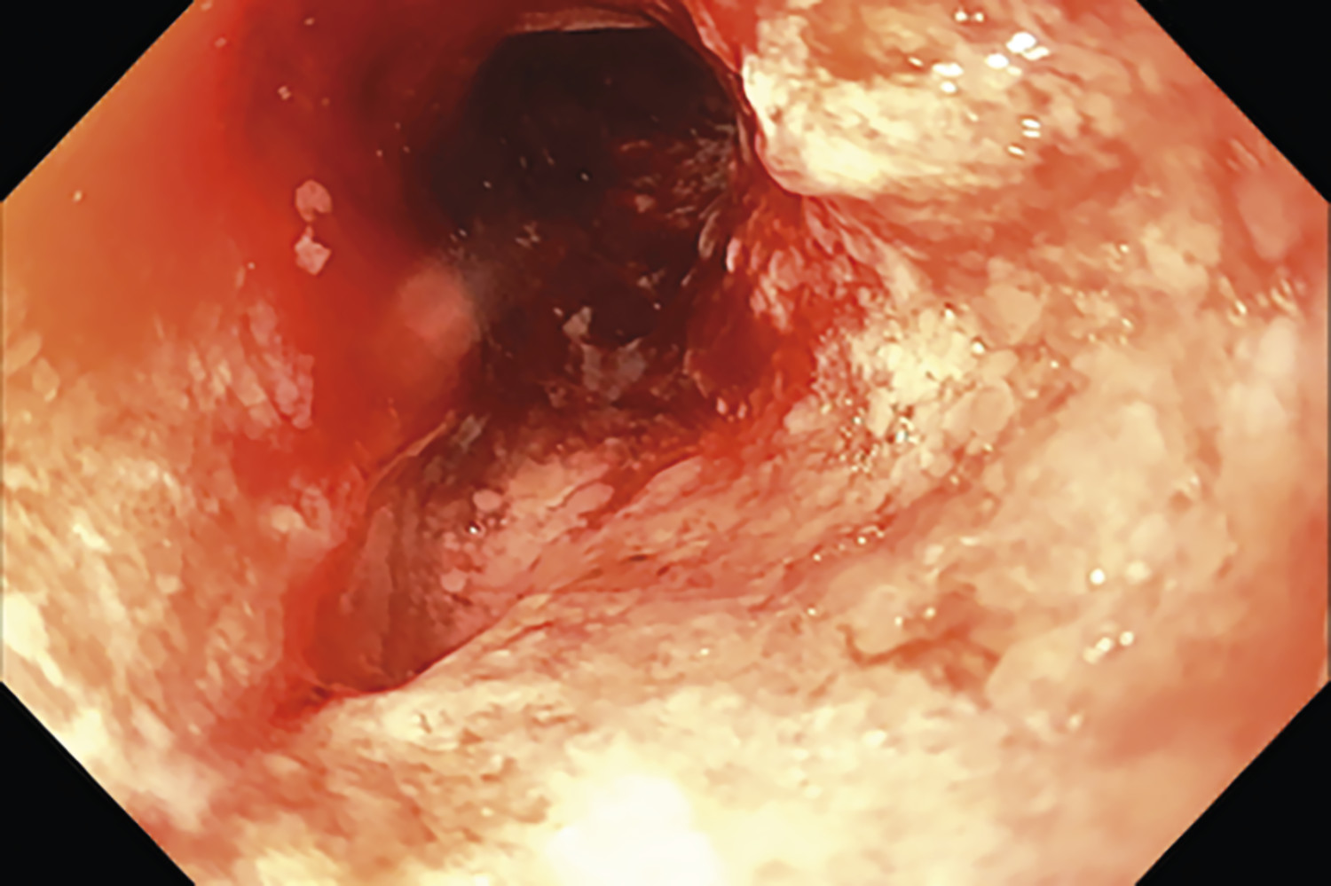 Sténose bulbaire chez une patiente atteinte de maladie de Crohn pédiatrique - Figure 2