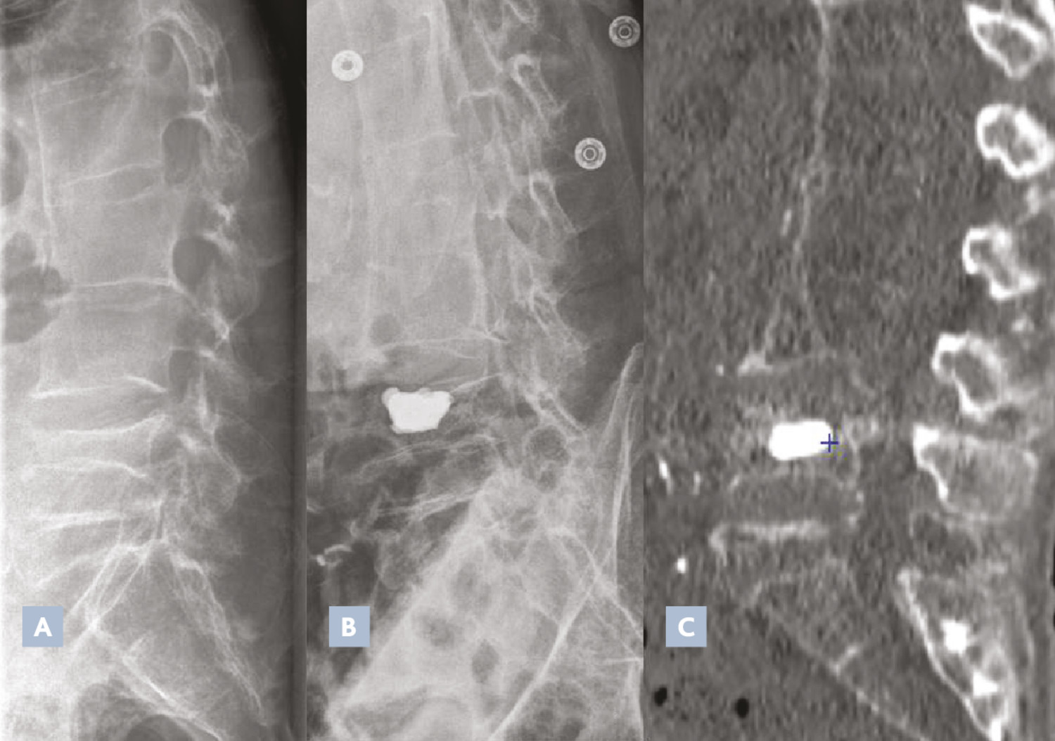 Traitement de la fracture vertébrale ostéoporotique par vertébroplastie :quand et pour qui ? - Figure 3