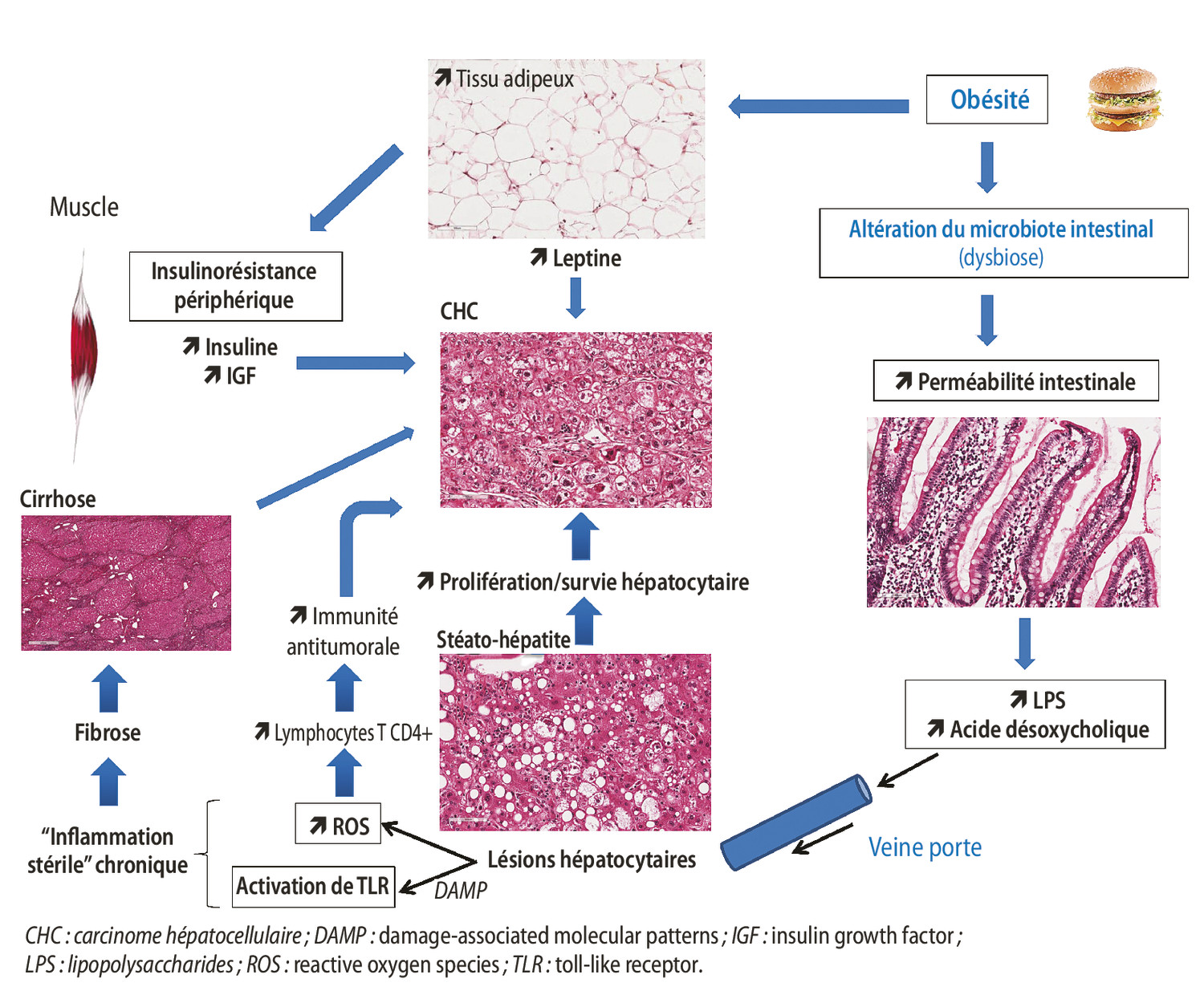 De la stéatopathie métabolique au carcinome hépatocellulaire - Figure 2