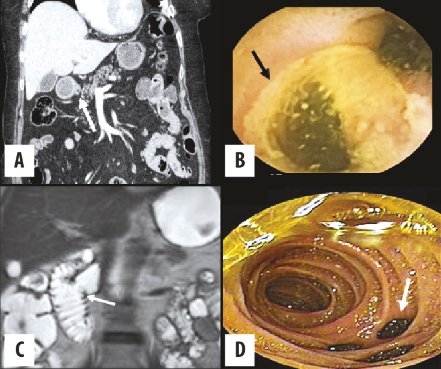 Comment explorer l’intestin grêle - Figure 3