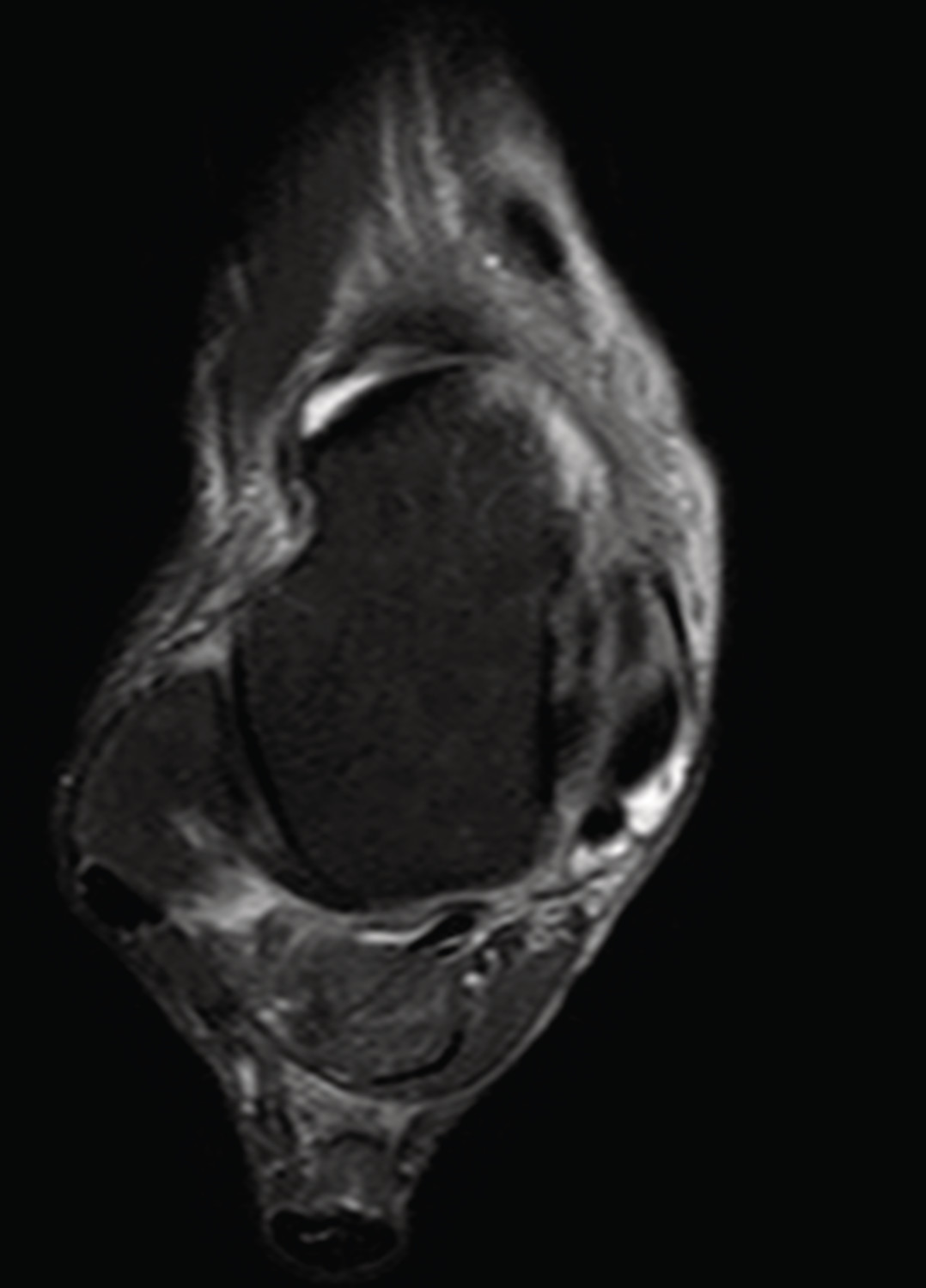 Les pathologies du tendon tibial postérieur - Figure 5