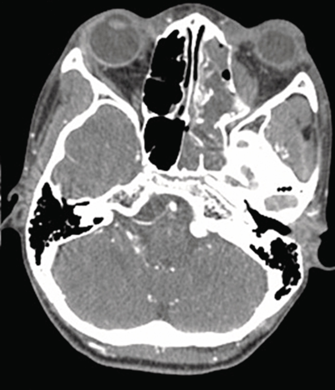 Localisation intranasale d’un projectile après un traumatisme balistique craniofacial - Figure 3