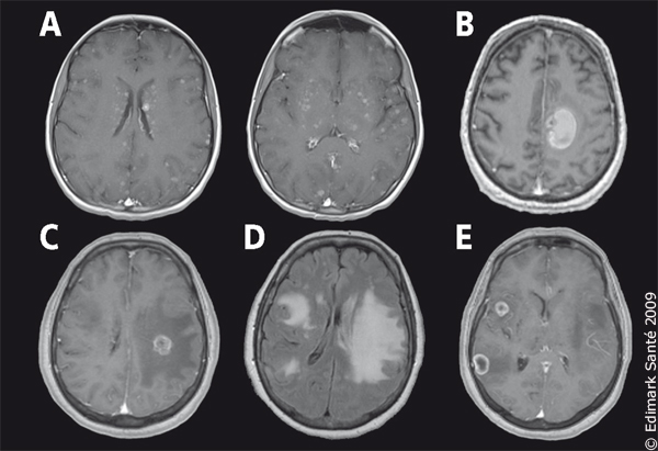 Caractéristiques radiologiques des métastases cérébrales-Figure 1. 