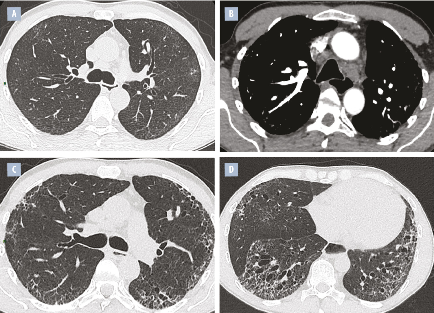 Traitement de la fibrose pulmonaire associée à la sclérodermie - Figure 1