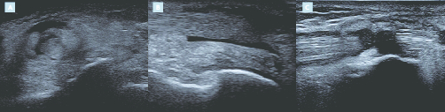 Les pathologies du tendon tibial postérieur - Figure 4
