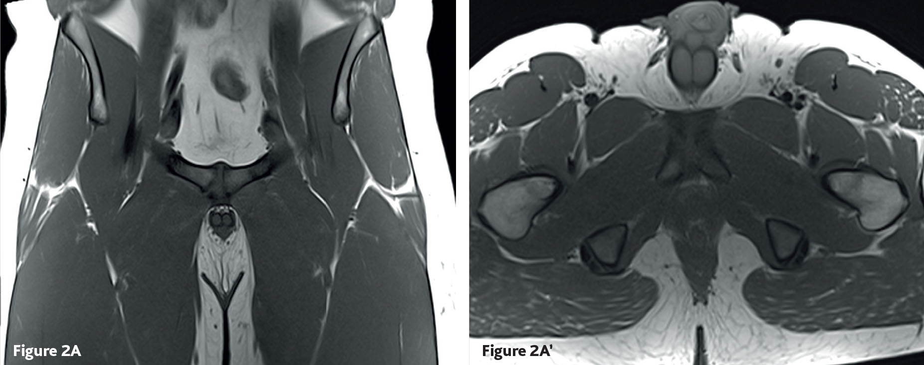 Pubalgie : ostéoarthropathie pubienne et enthésopathie du tendon conjoint long adducteur-gracile - Figure 2
