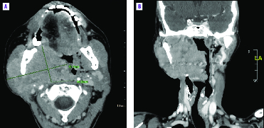 Réponse spectaculaire à l’entrectinib, un inhibiteur de NTRK, chez une patiente porteuse d’une tumeur sous-mandibulaire rare - Figure 1