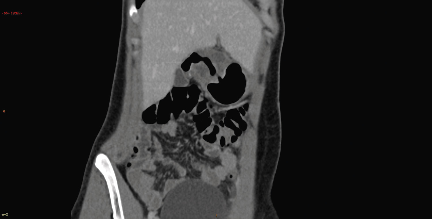 Sténose bulbaire chez une patiente atteinte de maladie de Crohn pédiatrique - Figure 4