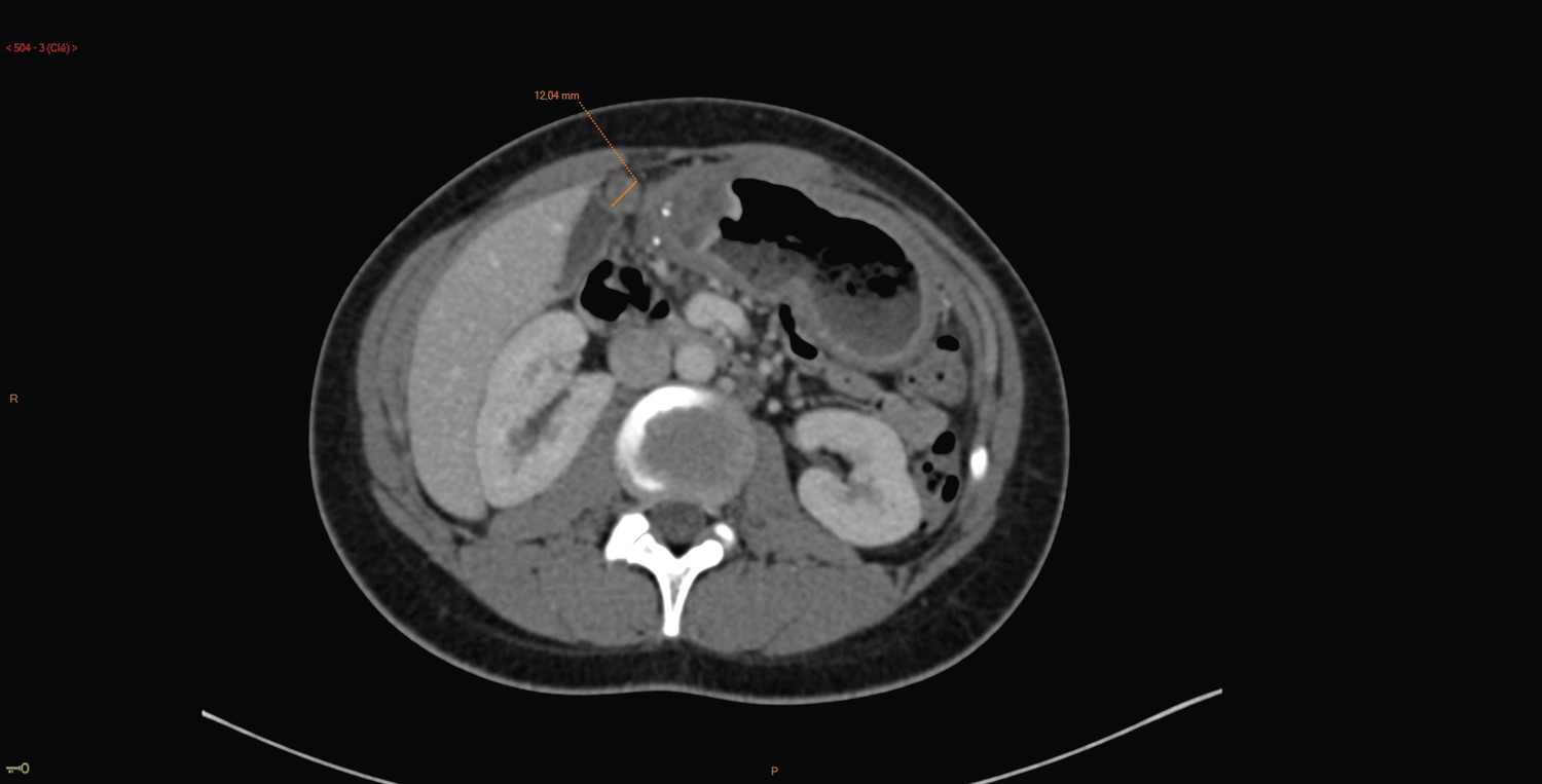 Sténose bulbaire chez une patiente atteinte de maladie de Crohn pédiatrique - Figure 5