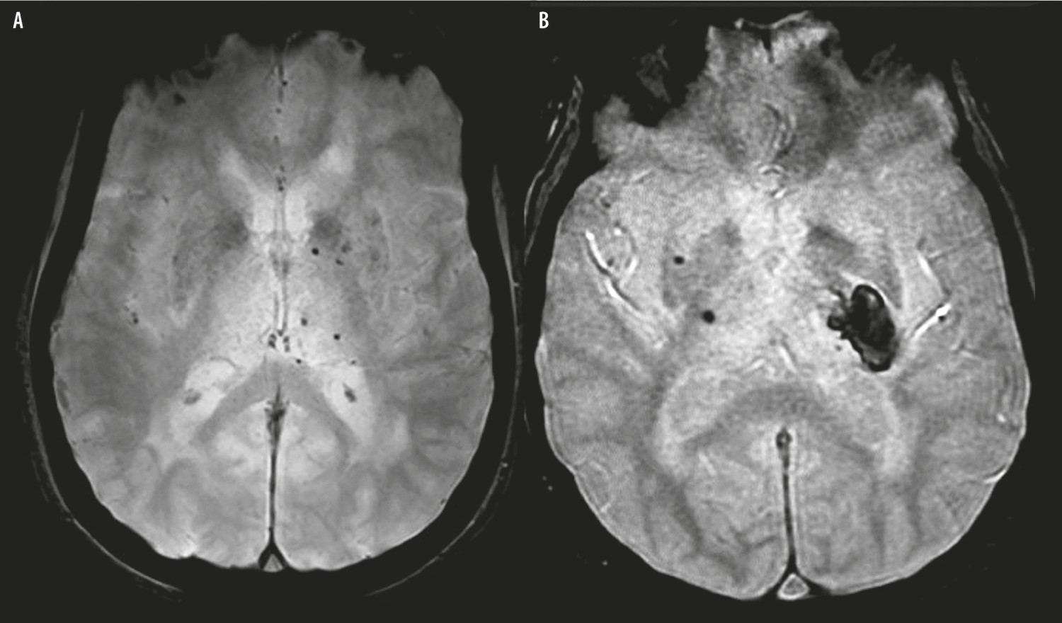 Microsaignements cérébraux et utilisation des traitements en neurologie vasculaire - Figure 2