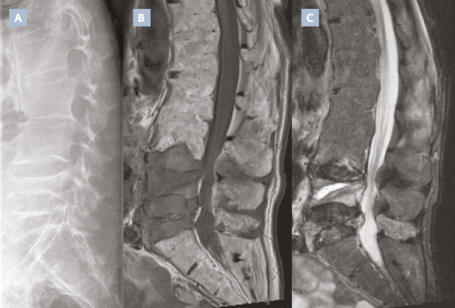 Traitement de la fracture vertébrale ostéoporotique par vertébroplastie :quand et pour qui ? - Figure 1