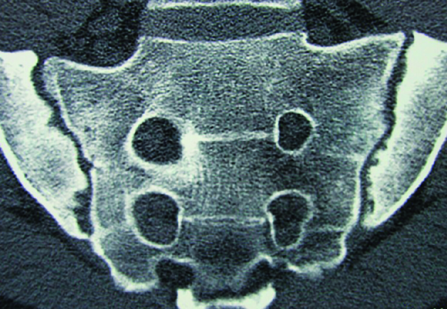 Quelle imagerie pour l’évaluation des articulations sacro-iliaques dans la spondyloarthrite axiale ? - Figure 2