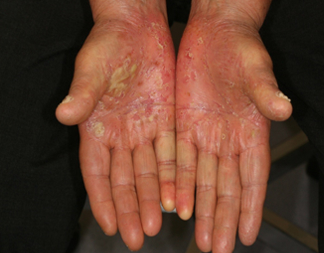 Quand les pustules pullulent-Lésions de psoriasis pustuleux des mains