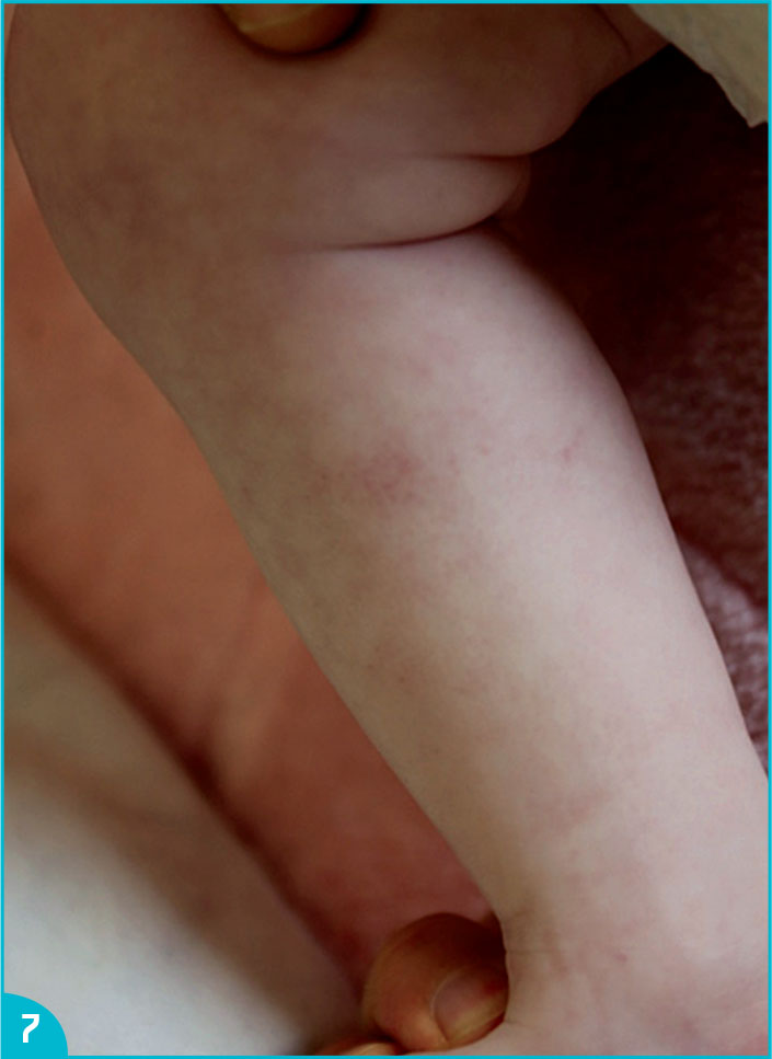 Le syndrome d'Hermansky-Pudlak, un albinisme syndromique - Figure 7