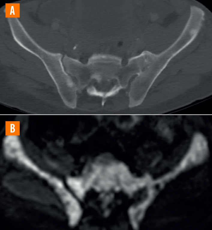 IRM corps entier dans le cancer de la prostate - Figure 2