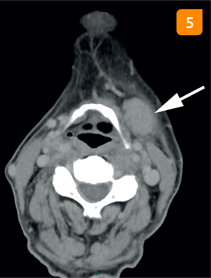 Douleurs abdominales et syndrome inflammatoire accompagnant un myélome multiple indolent - Figure 5