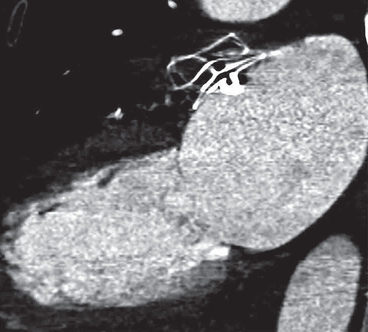Fermeture percutanée de l’auricule gauche : prévenir l’AVC chez les patients en fibrillation atriale - Figure 3