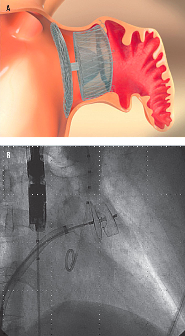 Fermeture percutanée de l’auricule gauche : prévenir l’AVC chez les patients en fibrillation atriale - Figure 4