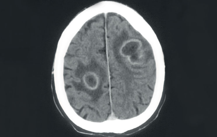 Les abcès cérébraux - Figure 3