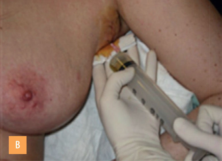 Chirurgie ambulatoire et curage axillaire - Figure 3b