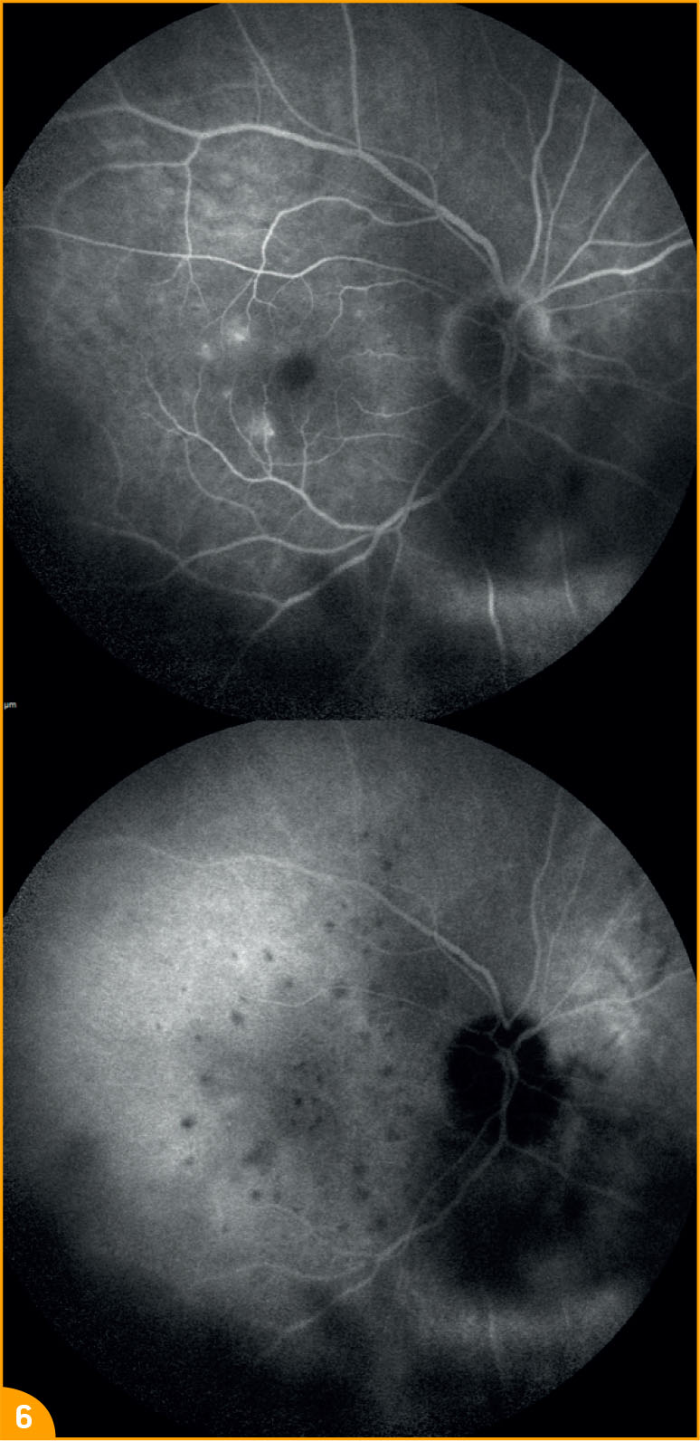 Lymphome intra-oculaire bilatéral - Figure 6