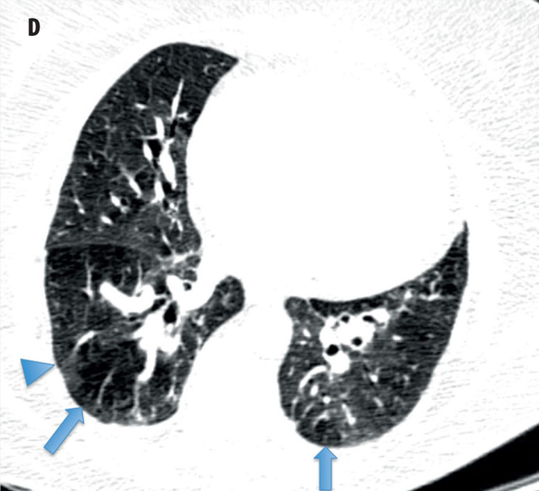 Rôles de l’imagerie dans l’hypertension pulmonaire-Figure 2D