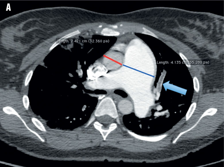 Rôles de l’imagerie dans l’hypertension pulmonaire-Figure 2A