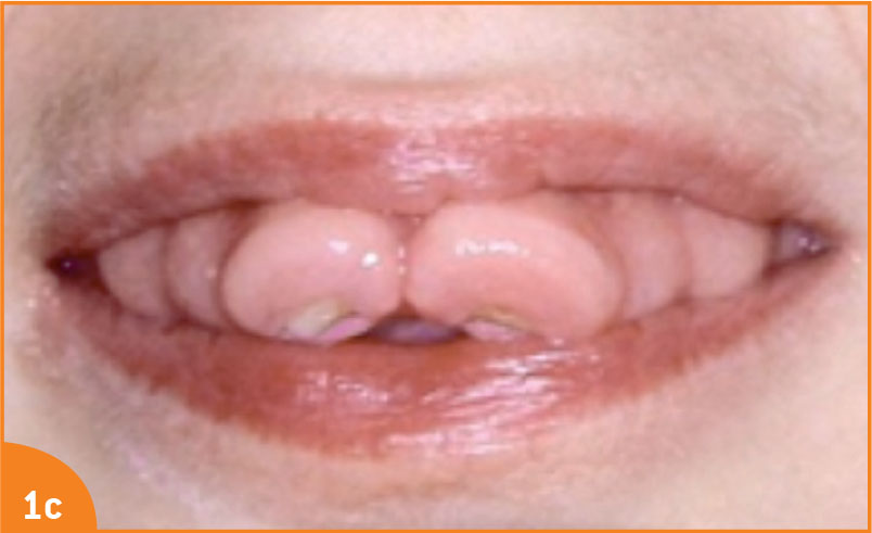 Les lésions gingivales provoquées par des médicaments - Figure 1c