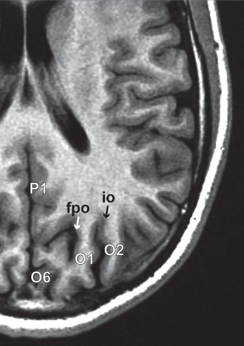 Anatomie du cortex cérébral : lobe occipital - Figure 4