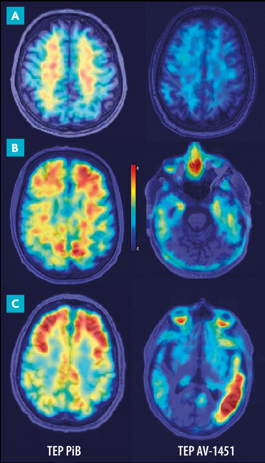 Imagerie TEP : intérêt des nouveaux ligands dans la maladie d’Alzheimer et les maladies apparentées - Figure 1